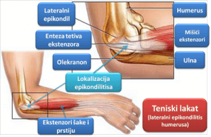 Teniski lakat: Terapije za otklanjanje bola u ramenima i upale tetiva i mišića